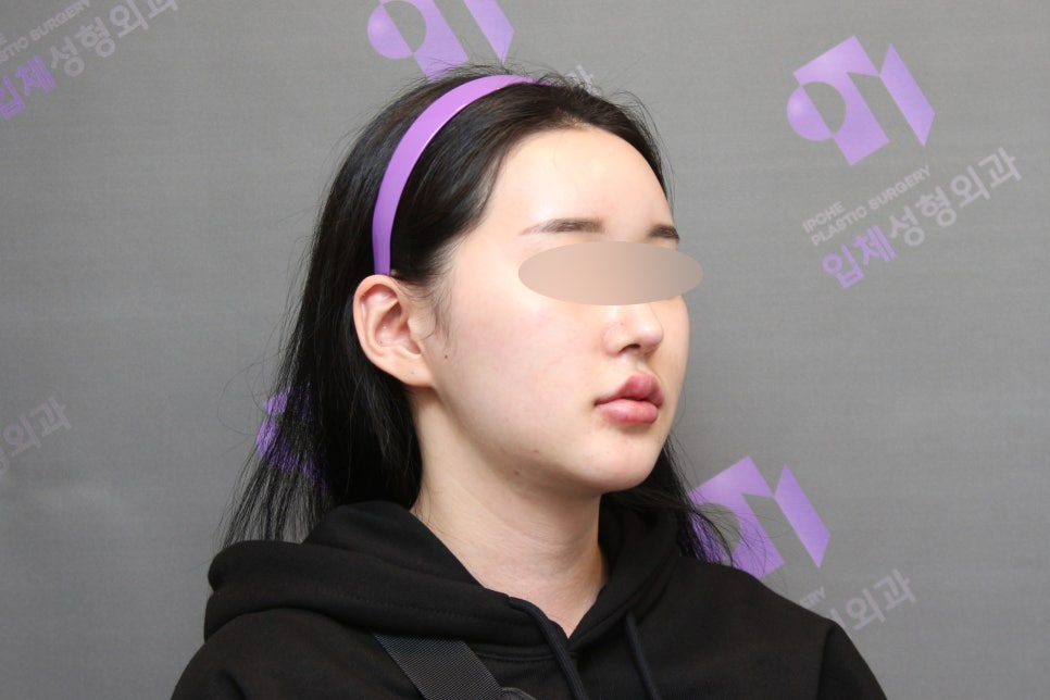 Why Cheekbones Show When You Smile, and Why Cheekbone Surgery May Not Help - Explained by a Specialist image 7