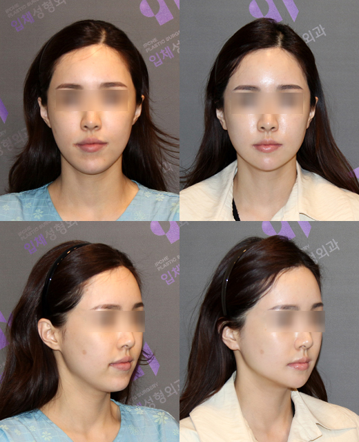 Is facial contouring surgery possible even at an older age? Important things you should know image 7
