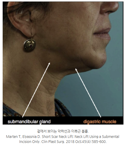 The 4-Step Secret of Double Chin Soft Contouring (Submental Lift): From Incision to Muscle Tightening image 3