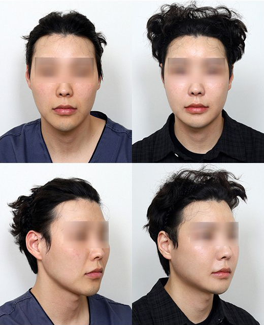 이런 분들은 230도입체광대축소술, 하지 마세요! 관련 이미지 2