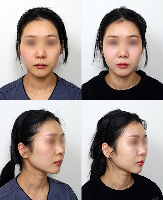 땅콩형 얼굴, 안면윤곽 수술로 해결할 수 있을까요? 관련 이미지 3