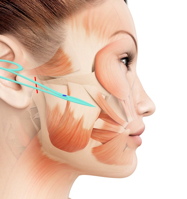 How effective is the incision method compared to the non-incision method for cheek hollow correction? image 3