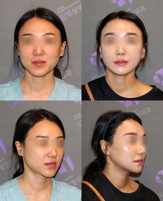 신경선이 낮으면 사각턱수술 못하나요? 정면에서 갸름해질 수 있는 방법은 없을까요? 관련 이미지 4