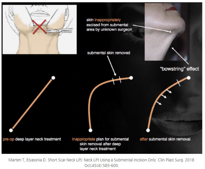 3 Face Types That Benefit from Submental Lift Surgery image 2