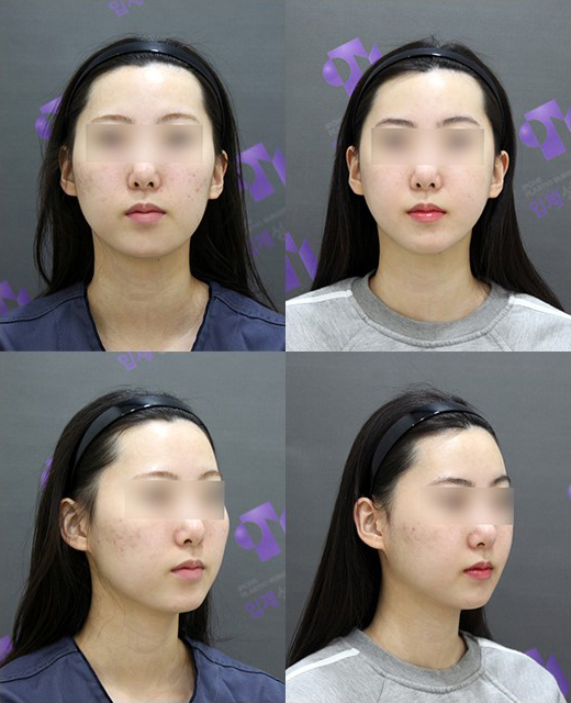 Facial Contouring A to Z: What Is Contouring Surgery? image 3