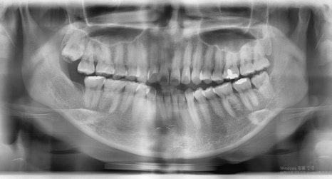 Which Surgery Do I Need: Contouring Surgery or Double-Jaw Surgery? image 8
