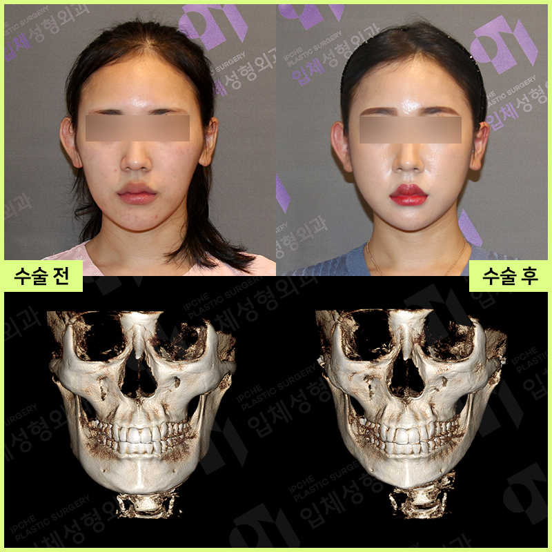 Why Consultation and Design Are Important Before Facial Contouring Surgery—Don’t Be Careless!! image 5