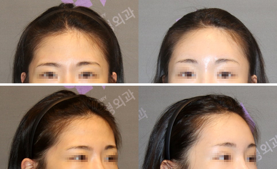 How Should a Prominent Brow Bone Be Addressed? image 4