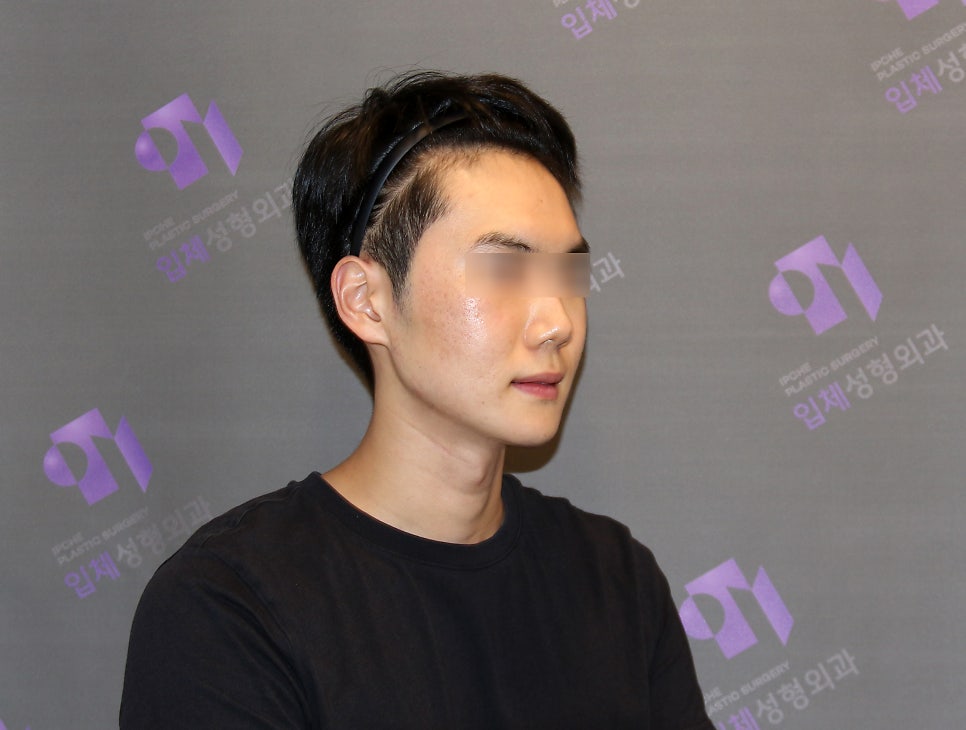 Male Facial Contouring (Zygoma Surgery, Square Jaw Surgery, Chin Surgery) - Explained by a Specialist. image 5