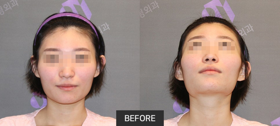 Lateral Cheekbone Reduction, 230-Degree Three-Dimensional Cheekbone Reduction from the Front to the Side image 3