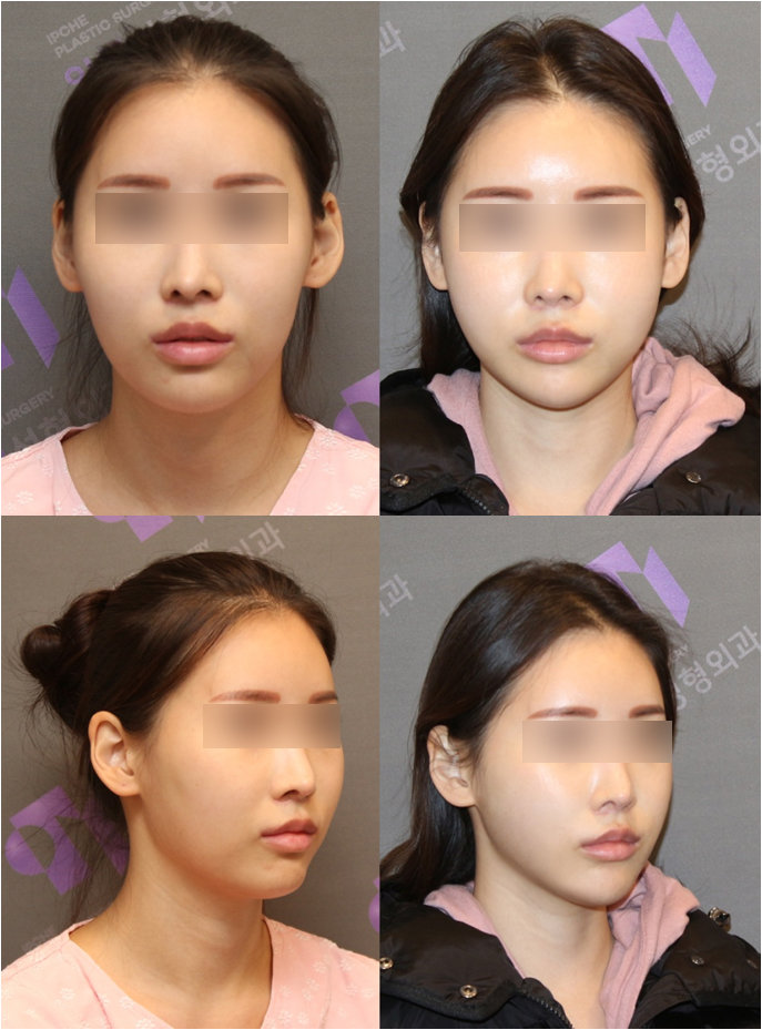 광대수술 볼처짐의 원인이라는 박리범위 제대로 파헤쳐봅니다. 관련 이미지 6