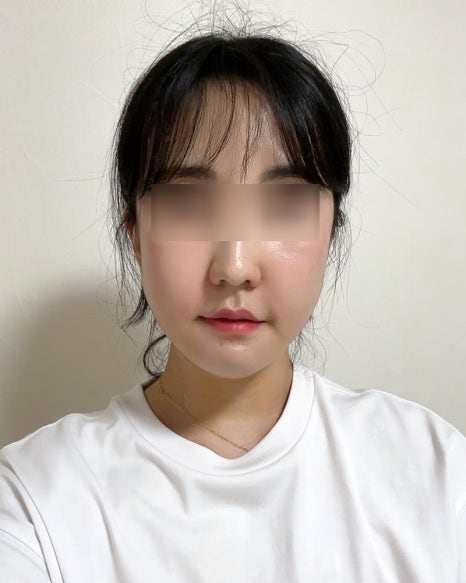 How Long Do Facial Contour Changes Continue After Facial Bone Contouring Surgery? (Day 1 to Day 365) — See With Photos image 4