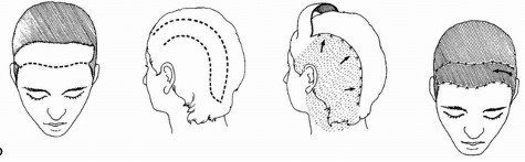 The Hidden History of Forehead Reduction Surgery &ndash; From Wong Fei-hung to Hair Transplantation and Modern Aesthetics image 2