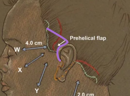 Is it possible to do a mini neck lift on its own? image 1