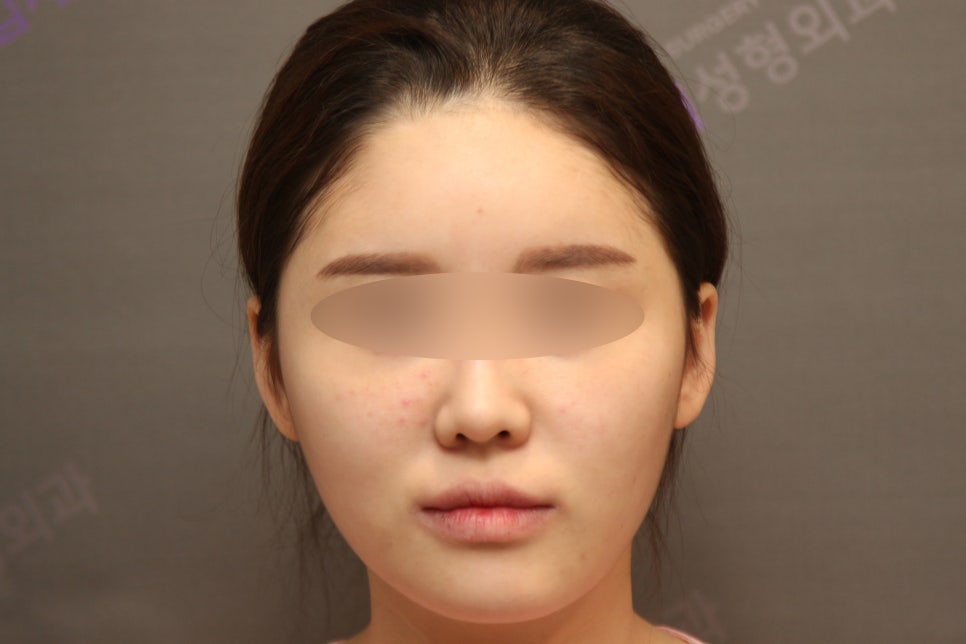 안면윤곽, 연예인 신세경처럼 예뻐질수 있을까요? -전문의가 알려드립니다. 관련 이미지 1