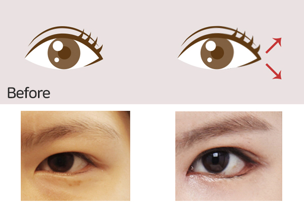 Surgery That Goes Well with Cheekbone Surgery, Part 1: Lateral and Lower Canthoplasty image 4