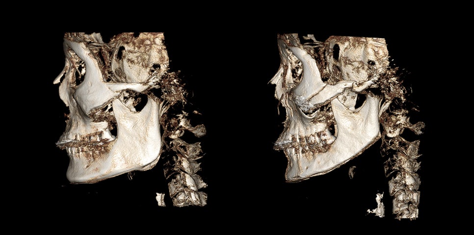 Side Effects of V-Line Square Jaw Surgery, Common Traits of People Who Experience Failed Results image 4