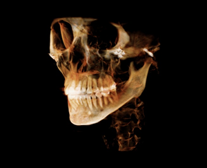 After Facial Contouring Surgery: Asymmetry, When Can Revision Surgery Be Performed? image 7