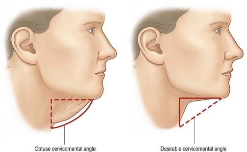 How Should Double Chin and Skin Sagging After Contouring Surgery Be Addressed? image 4