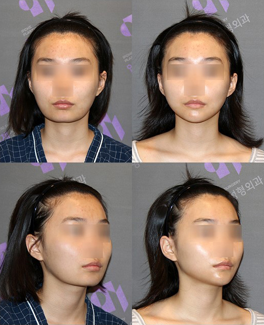 턱보조개, 갈라진턱, 엉덩이턱은 어떻게 해결해야 할까요? 관련 이미지 8