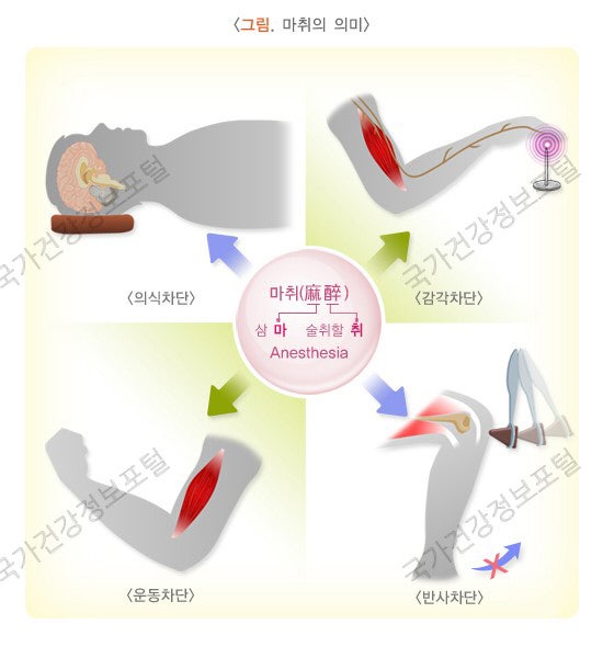전신마취 후유증에 대해서 알아봅시다. 관련 이미지 1