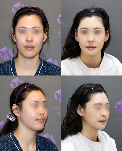 What Are the Features of a Youthful Face? Why Does a Small Chin Make a Face Look Younger? image 8