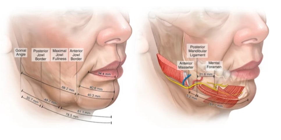 If you’re worried about jowls (bulldog cheeks) but were recommended buccal fat removal, what should you do? image 1