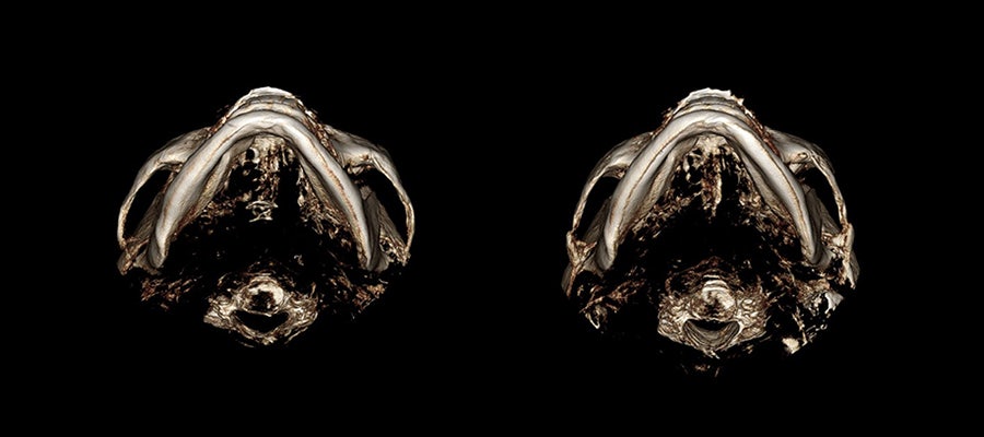 Cheekbone Reduction Surgery: A 2–3 mm Difference in the Side Cheekbones Makes a Big Change in the Face. image 2