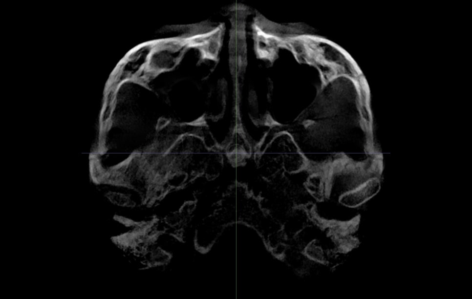 Is It Necessary to Remove the Fixation Pins After Facial Contouring Surgery? image 11