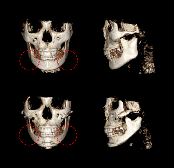 V-Line Square Jaw Surgery Is Good for the Front View Effect image 10