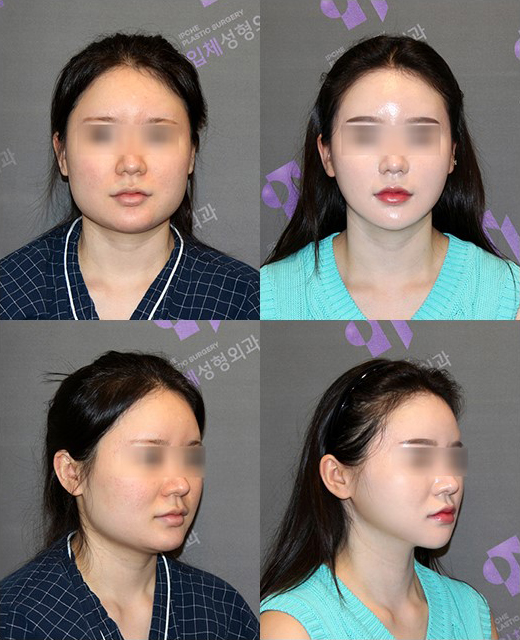 사각턱비대칭, 교근절제술(교근축소술)로 교정이 가능할까요? 관련 이미지 3