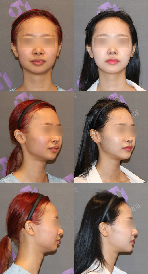 What Surgery Is Needed for a Long, Recessed Chin or a Short, Recessed Chin? image 7