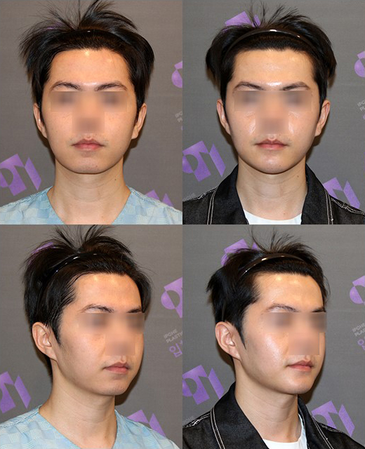 턱보조개, 갈라진턱, 엉덩이턱은 어떻게 해결해야 할까요? 관련 이미지 11