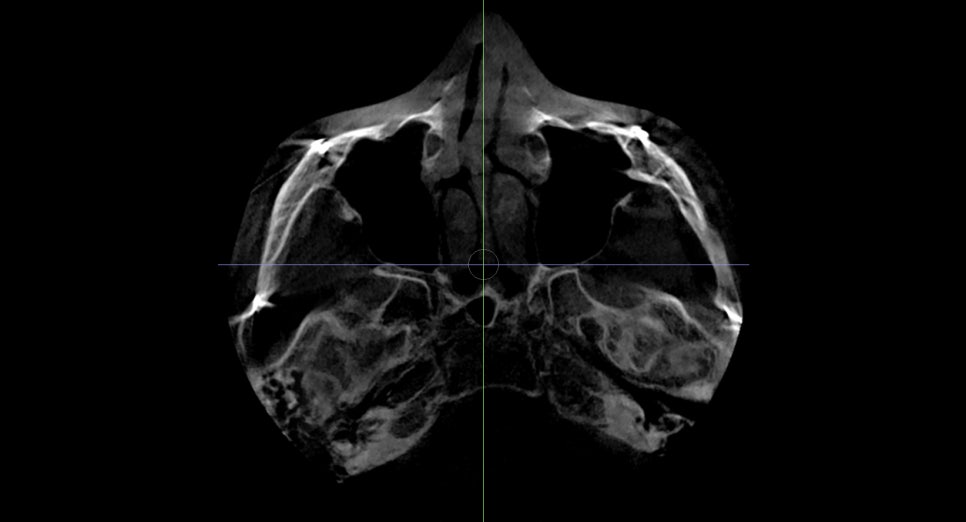 Back Cheekbone Shaving? Osteotomy? Do You Really Need It? image 10