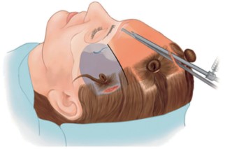 Why Do Eyebrows Sag Lower as We Age? - A Forehead Lift May Be the Solution. image 4