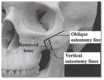 Why Are There So Many Methods for Cheekbone Surgery? A Look at Osteotomy Methods image 5