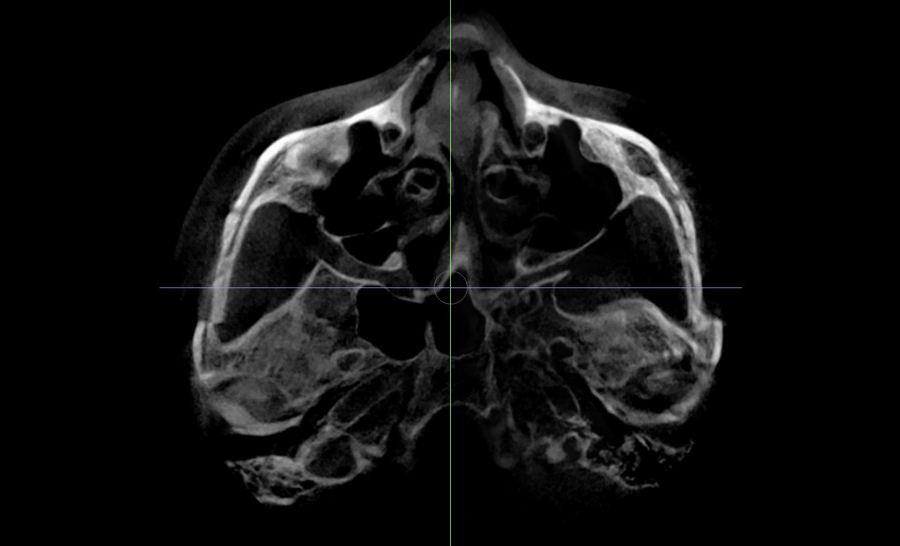 Is Pin Removal Surgery Necessary in Facial Contouring? Titanium Fixation Pins vs. Absorbable Fixation Pins image 5