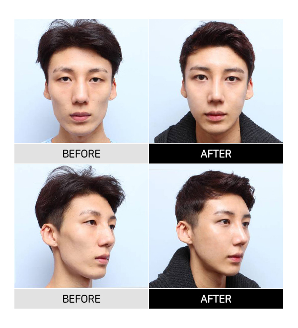 안면윤곽수술과 같이 하면 좋은 수술이 뭐가 있을까요? 관련 이미지 3