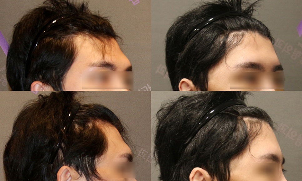 눈썹뼈돌출, 무조건 깎는 것이 답일까요? 눈썹뼈절삭부터 이마성형까지 관련 이미지 6