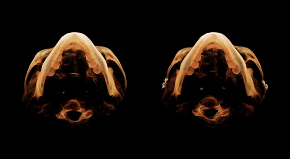 Non-fixation zygoma reduction surgery, will the bone heal properly? image 6