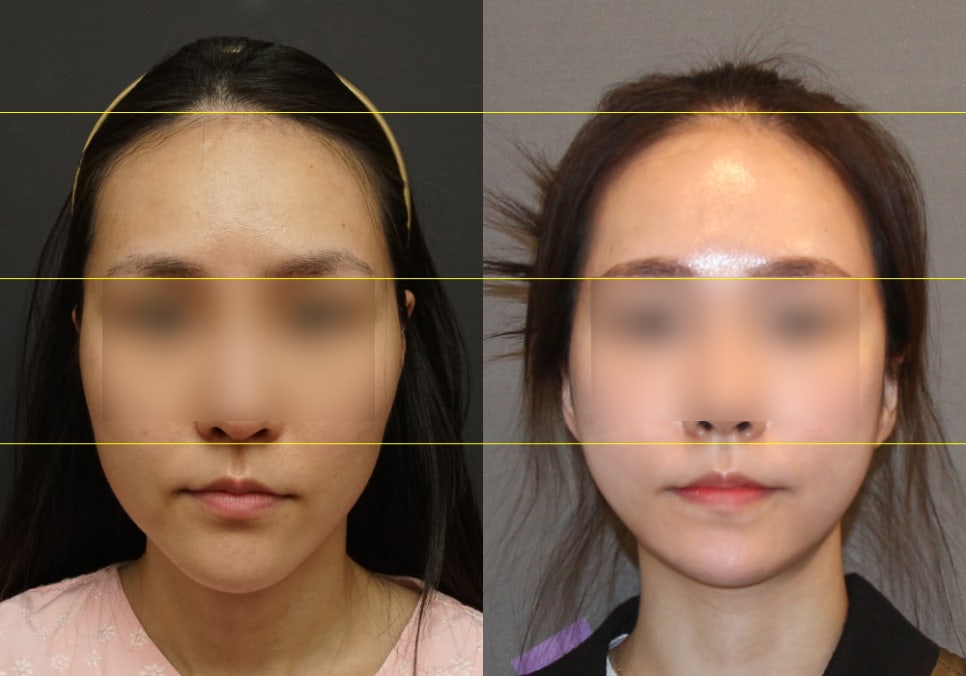 Doctor, Please Make My Face Shape Like a Celebrity’s! (Celebrity Proportions and Facial Contouring Surgery) image 6