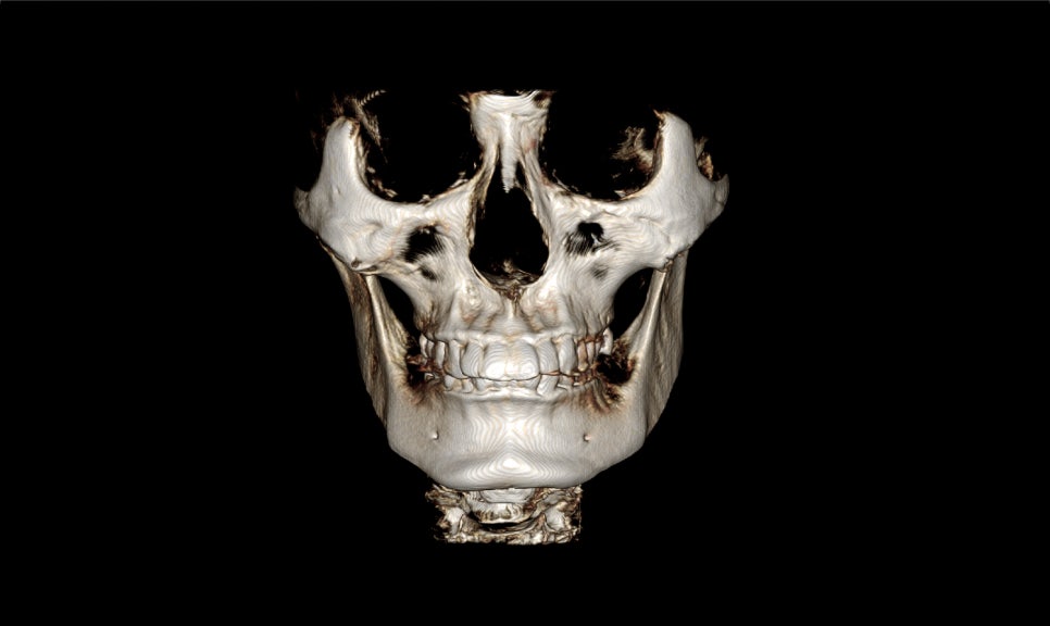 V-Line Square Jaw Surgery Is Good for the Front View Effect image 8