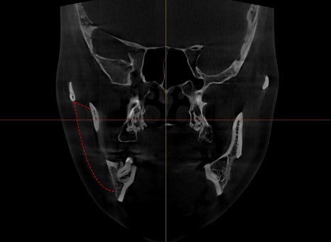 What Are Contouring 3, 4, and 5 Procedures, and Which Surgery Should I Have? image 7