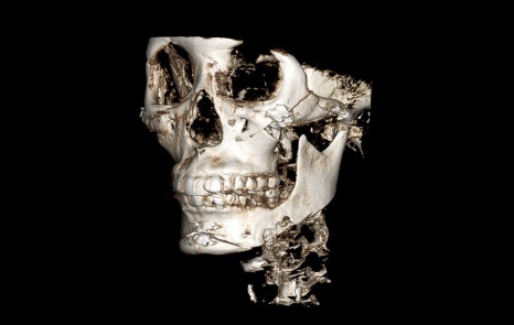 Are There People Who Can’t Have Cortical Ostectomy Surgery for a Frontal Square Jaw Effect? image 8