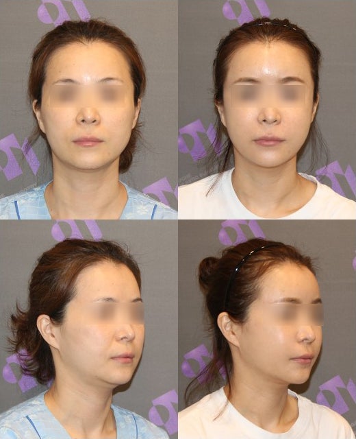 A Complete Summary of 6 Complications After Cheekbone Surgery: Sinusitis, Recurrence, Hollow Cheeks, and Sagging Cheeks image 10