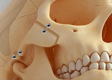 [Paper Review] The Extended Zygoma Reduction Surgery Recently in Vogue in Japan image 2