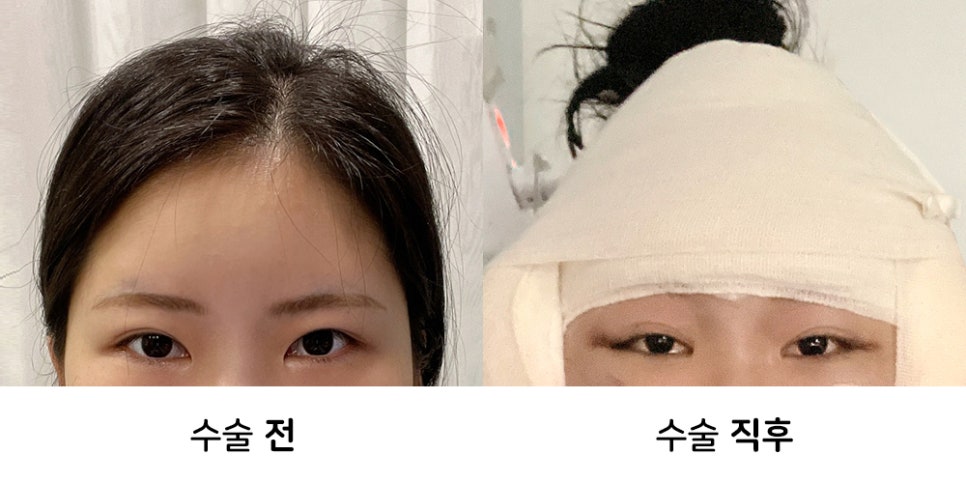 내시경이마거상술 붓기와 회복기간, 후기사진과 함께 알아보기 관련 이미지 1