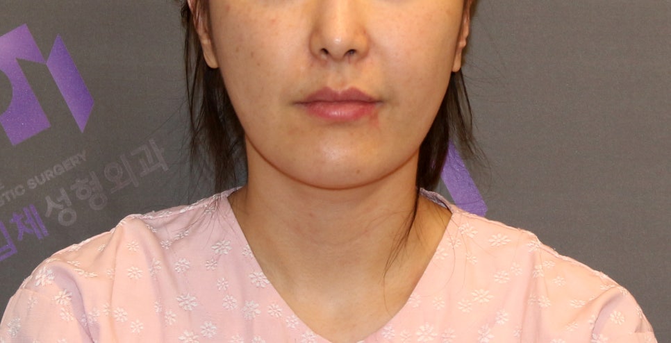 [Chin Surgery] Learning About Contouring Shave and T-Osteotomy with Real Patient Cases (2) image 13