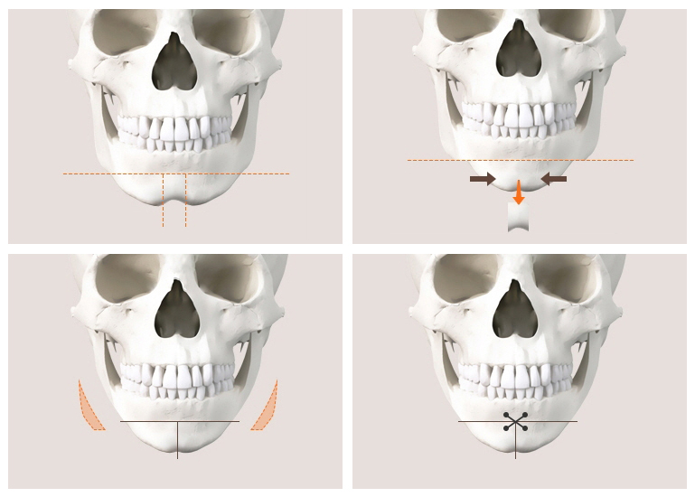 Why Are There So Many Different Chin Surgery Methods? Exploring Advancement, Setback, Reduction, and Lengthening image 1