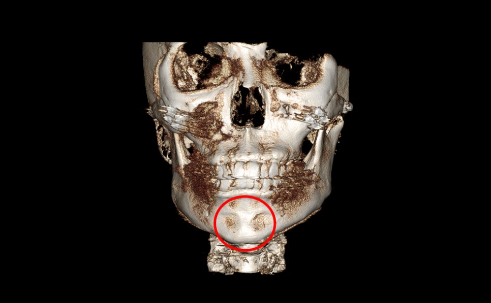 Does chin filler or an implant cause bone erosion? image 8
